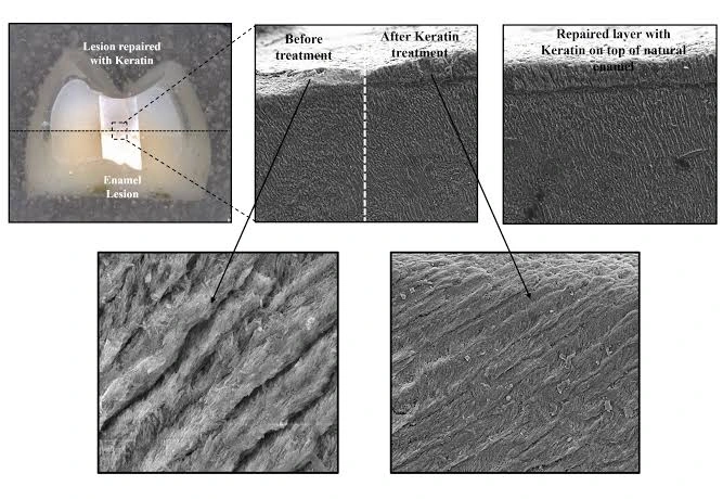إصلاح مينا الأسنان بالكيراتين : ثورة علمية جديدة
